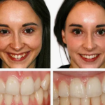Invisalign Manchester