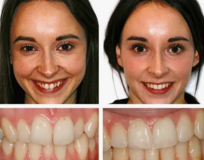 Invisalign Manchester