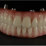 Same Day Dental Implants Manchester