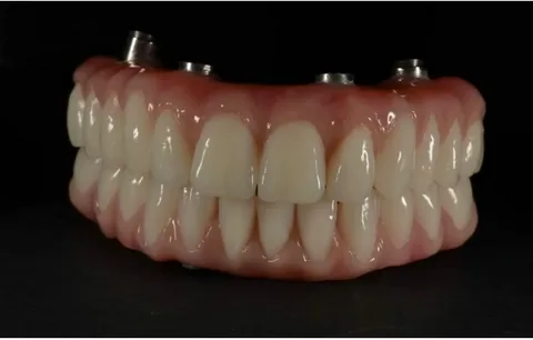 Same Day Dental Implants Manchester